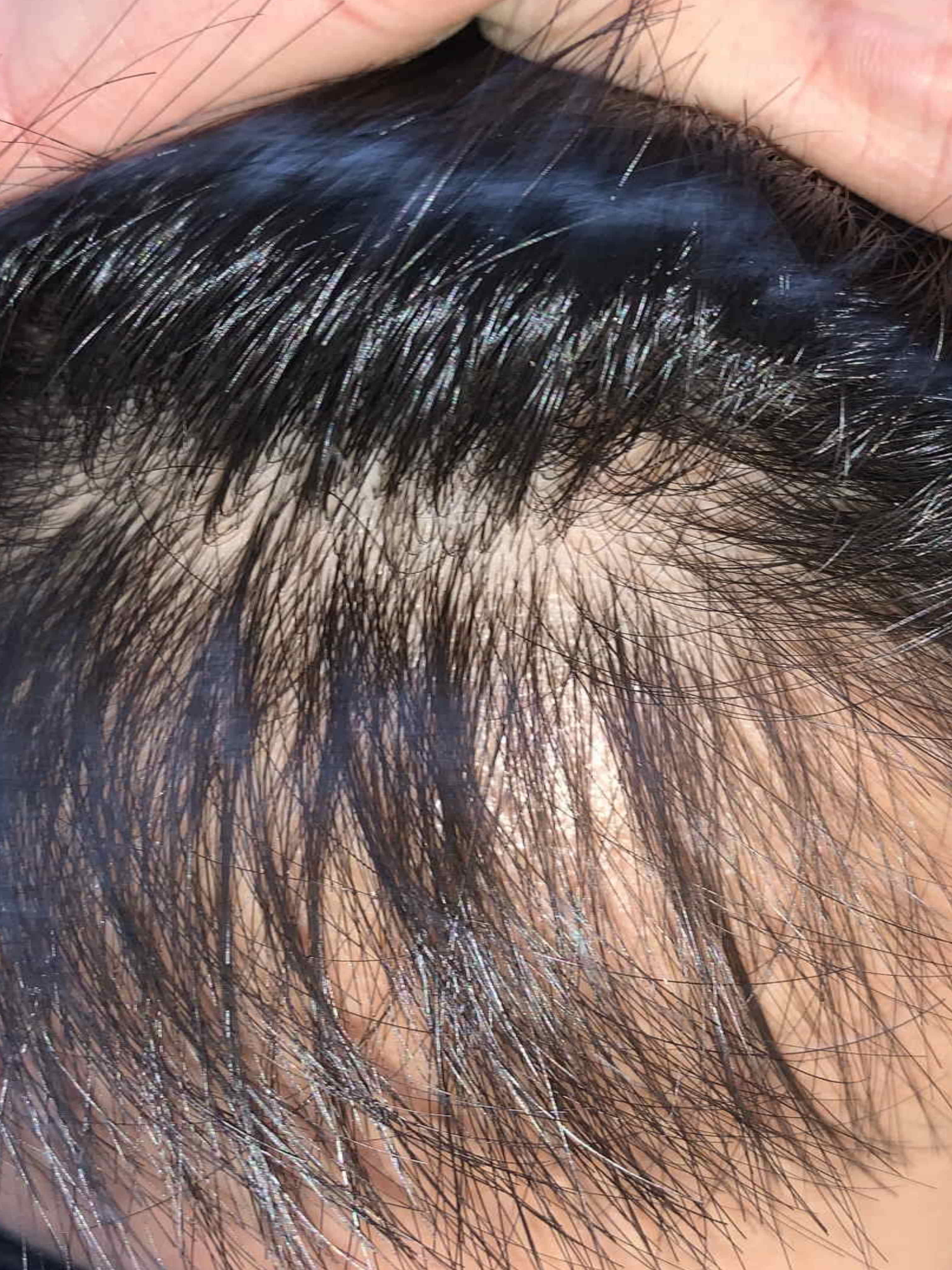 image of bald spot 3 in December