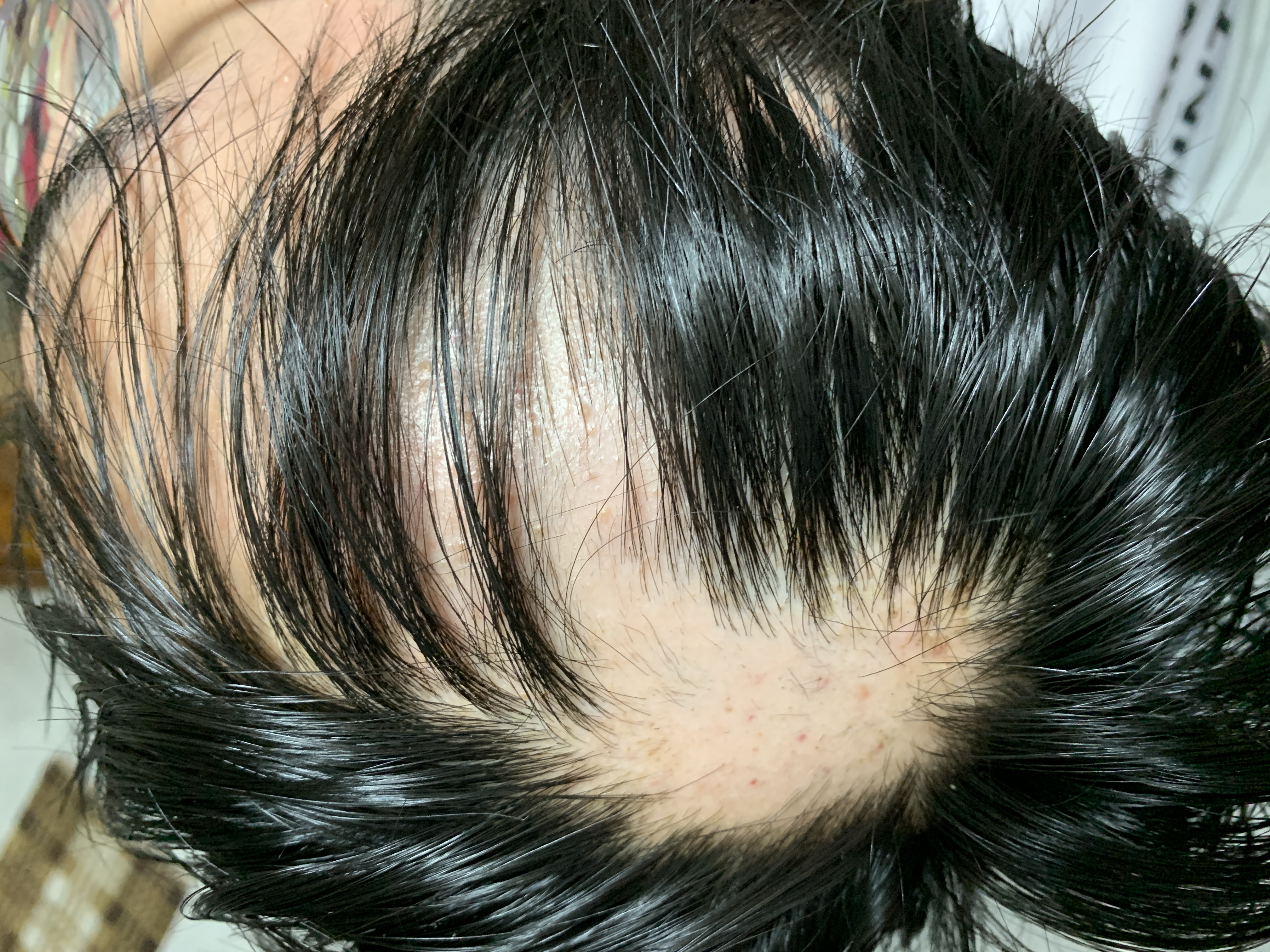 image of bald spot when starting Prednisolone